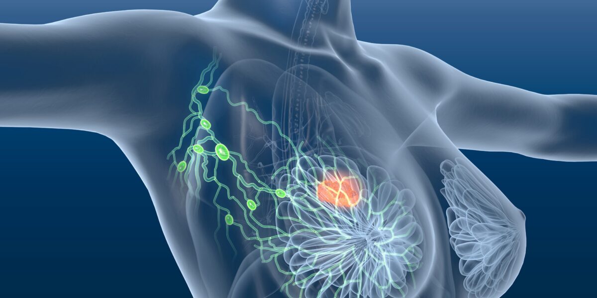 Рак молочной железы у беременных
