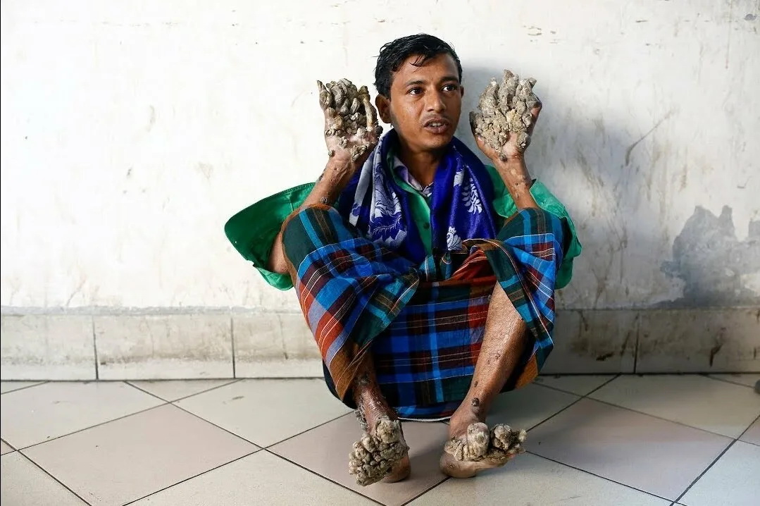 Люди-растения: миф или заболевание?