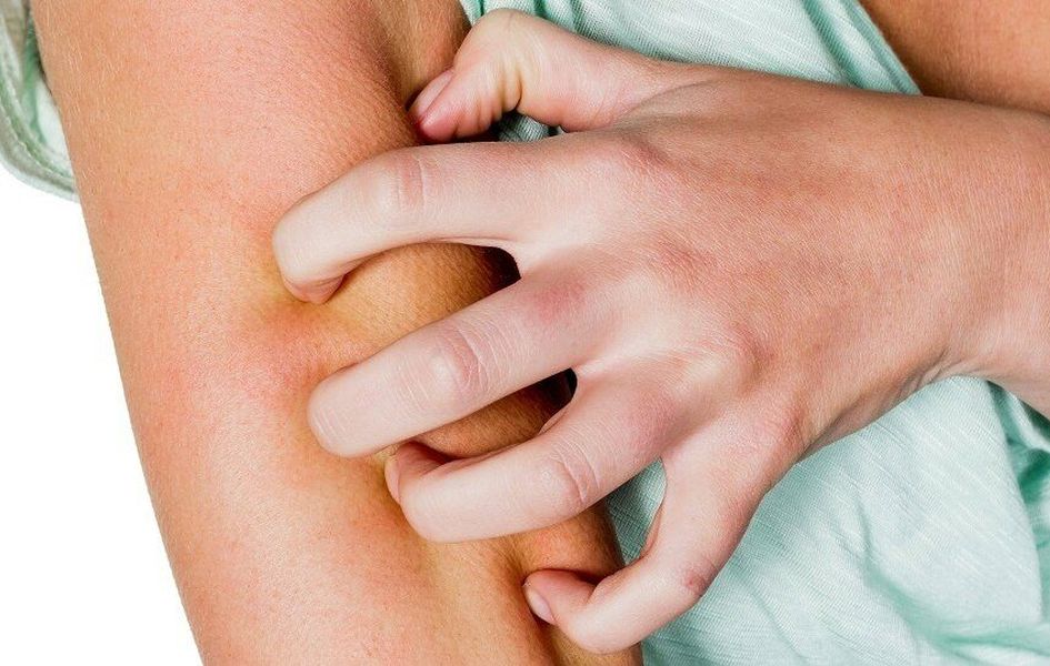 Зуд купальщика после пруда симптомы и помощь